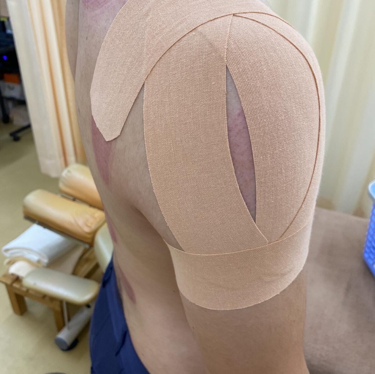 野球肩
